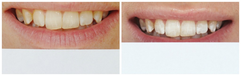Whitening Teeth