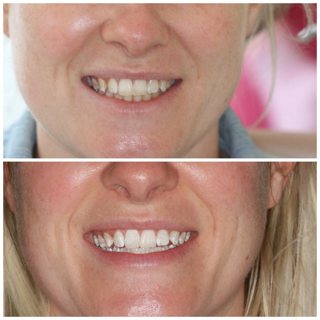 Elleven Dental Teeth Whitening